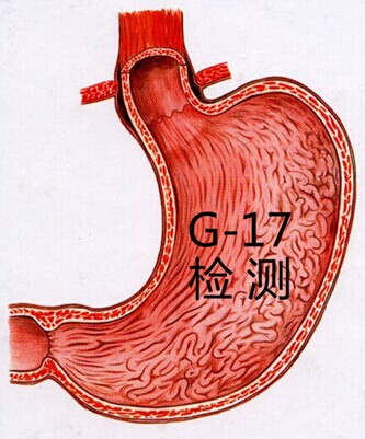 胃病筛查新利器“胃泌素17”